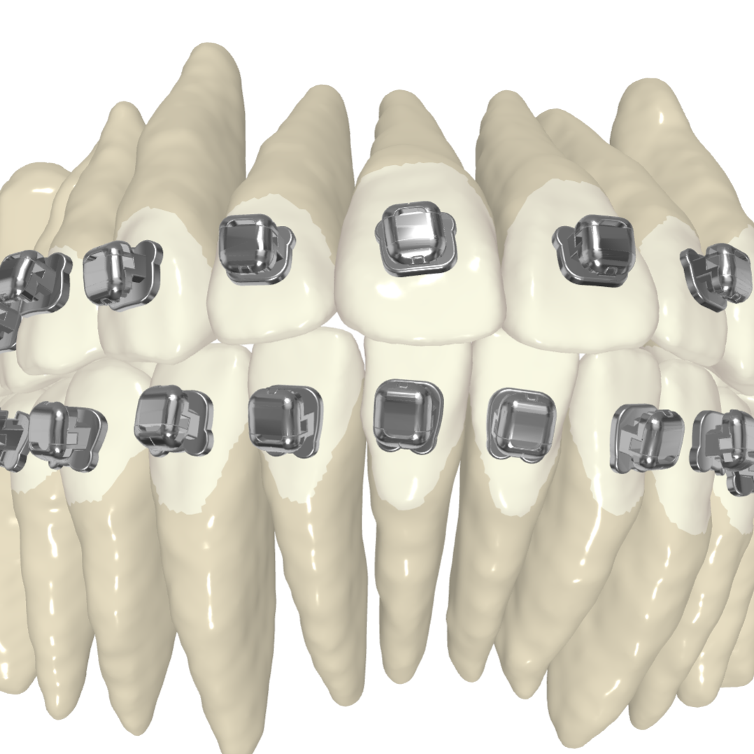 How Dream Smiles Custom Braces Make Treatment Faster and More Comfortable