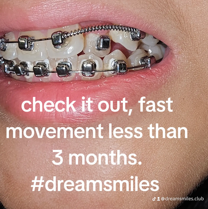 Why It’s Time to Ditch Traditional Braces for Custom Braces from Dream Smiles Club