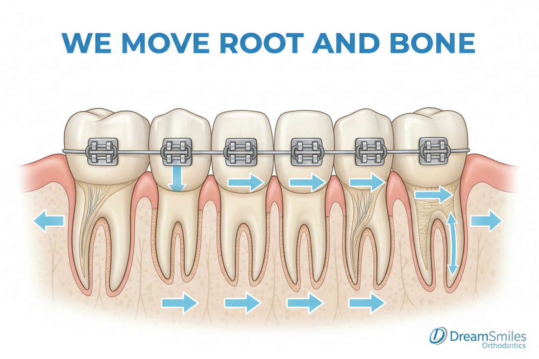 How Digital Scanning and Custom Brackets Improve Treatment Time with Dream Smiles Braces