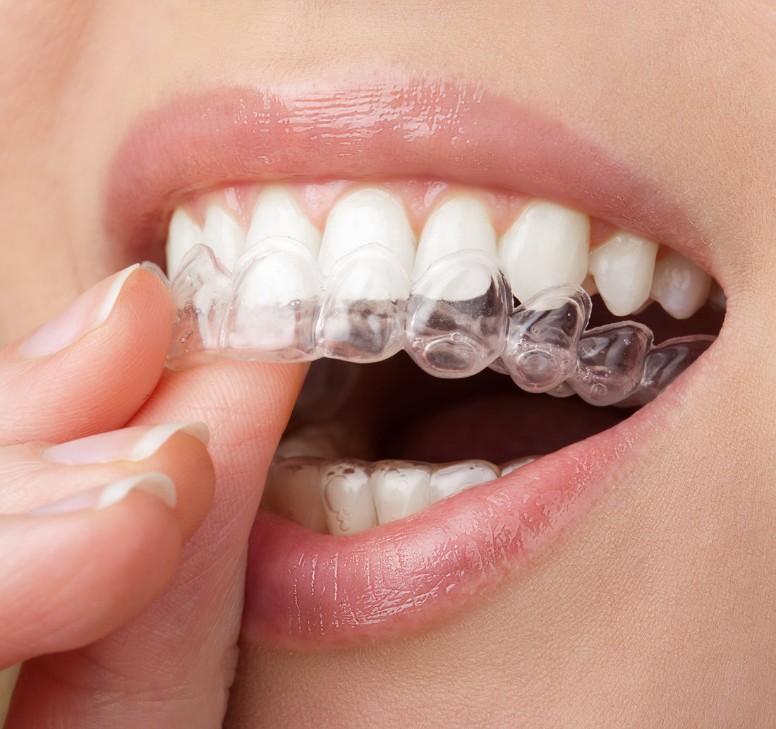 Top 5 Benefits of Choosing Dream Smiles Clear Aligners