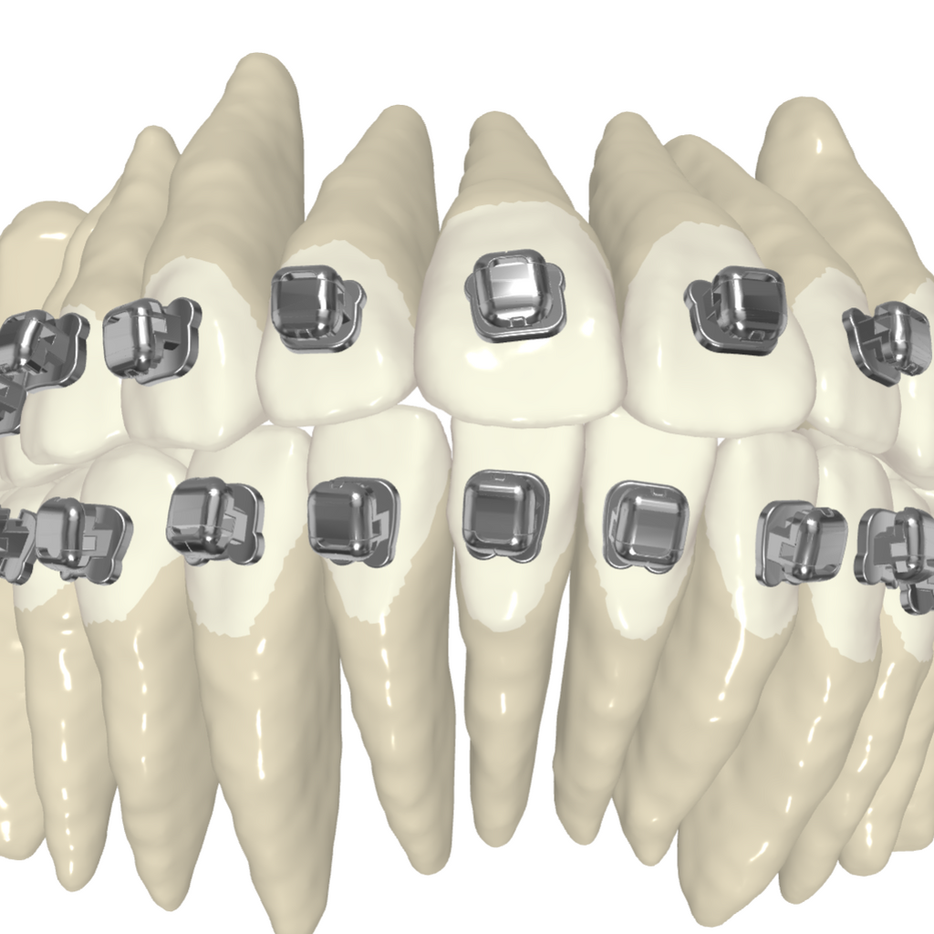 Orthodontic Custom Braces Treatment
