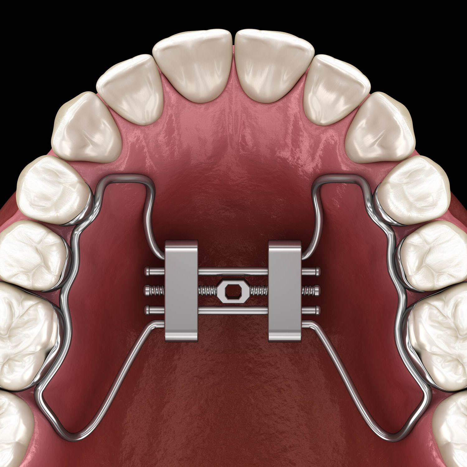 Orthodontic Custom Braces Treatment