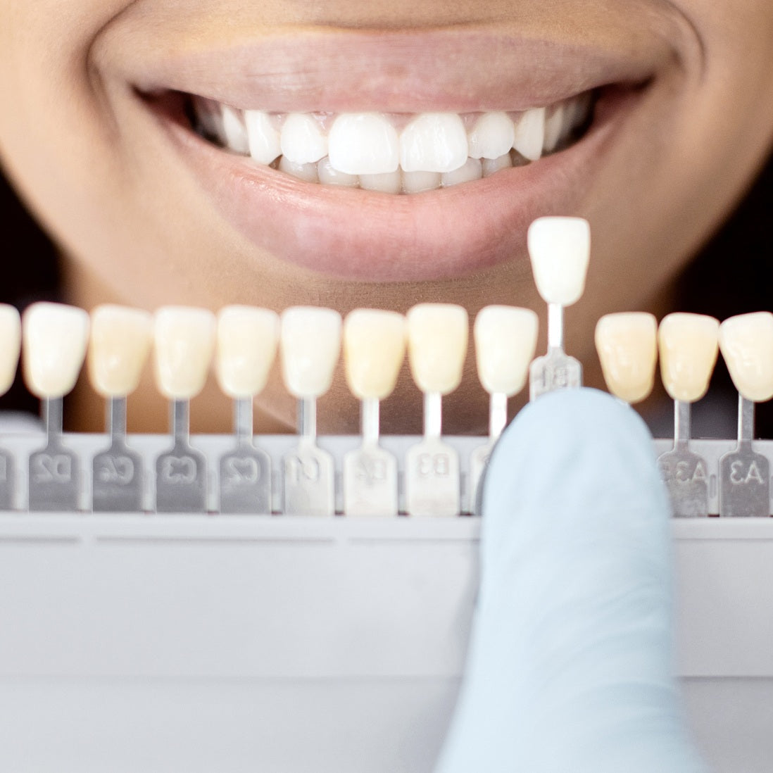 Zirconia Crown and Bridge