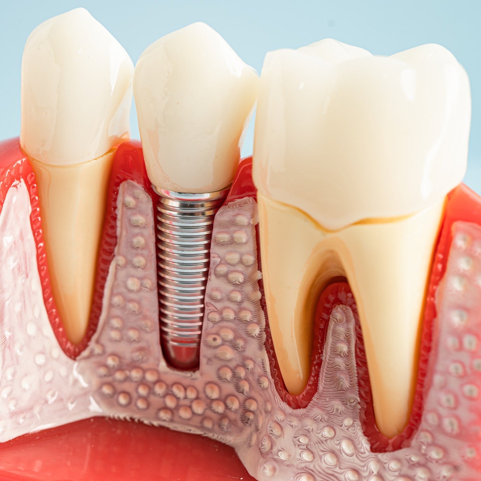 Tooth Implant package including zirconia crown