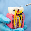 Root Canal Treatment