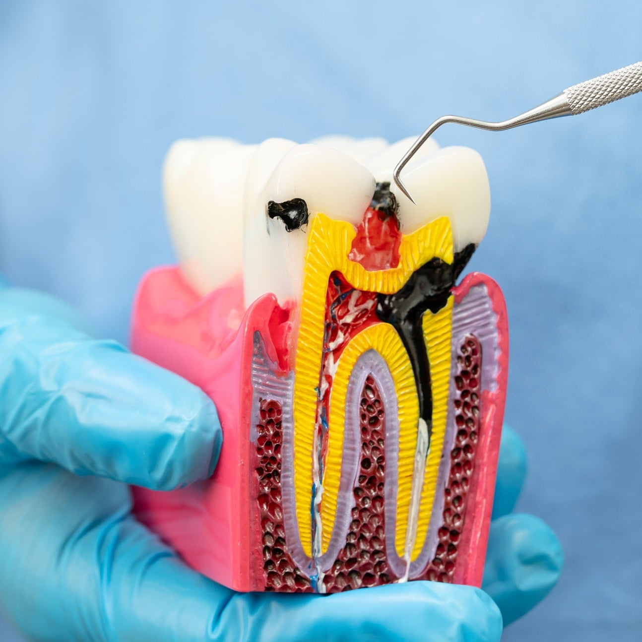Root Canal Treatment