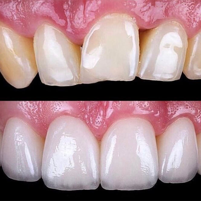 Porcelain Veneers each tooth
